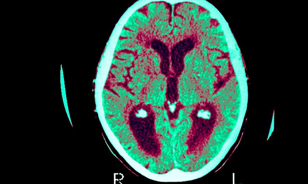 Alzheimer-hersens