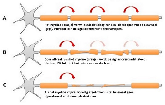 multiple sclerose