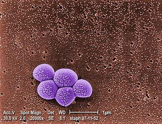 Multiresistente Staphylococcus aereus