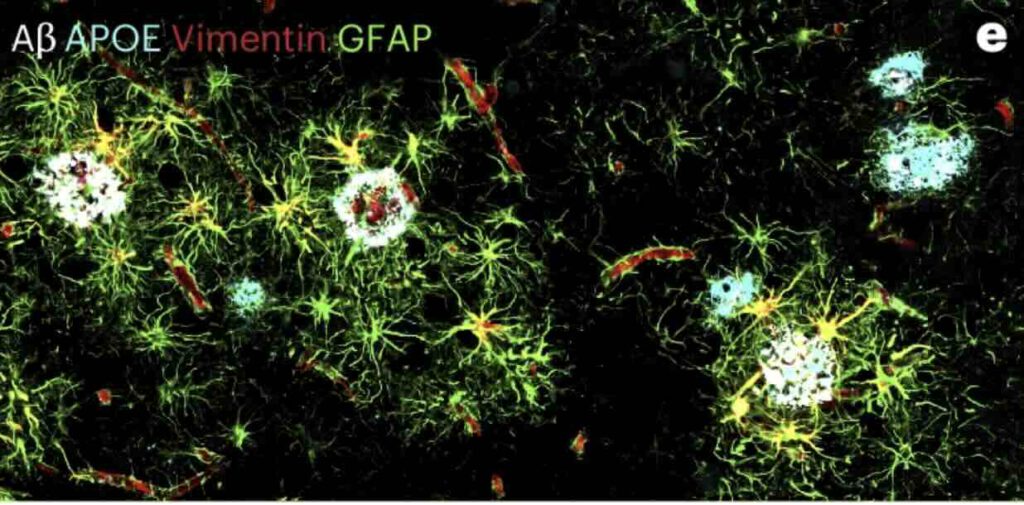 Beta-amyloïdeplaques en APoE-ophopingen nabij speciale (?) microgliacellen (Vimentin) 